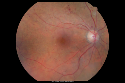Diabetic Macular Edema Left Eye - Pre Laser
82-year-old woman diabetic for many years, last eye exam 5 years ago with gradual vision loss.  OD 20/60, OS 20/70.  IOP:  OD 16, OS 17.

