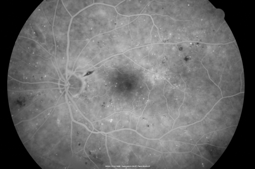 Diabetic Macular Edema Left Eye - Pre Laser
82-year-old woman diabetic for many years, last eye exam 5 years ago with gradual vision loss.  OD 20/60, OS 20/70.  IOP:  OD 16, OS 17.

