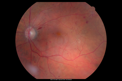 Diabetic Macular Edema Left Eye - Pre Laser
82-year-old woman diabetic for many years, last eye exam 5 years ago with gradual vision loss.  OD 20/60, OS 20/70.  IOP:  OD 16, OS 17.

