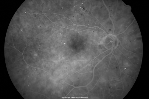 Diabetic Macular Edema Left Eye - Pre Laser
82-year-old woman diabetic for many years, last eye exam 5 years ago with gradual vision loss.  OD 20/60, OS 20/70.  IOP:  OD 16, OS 17.

