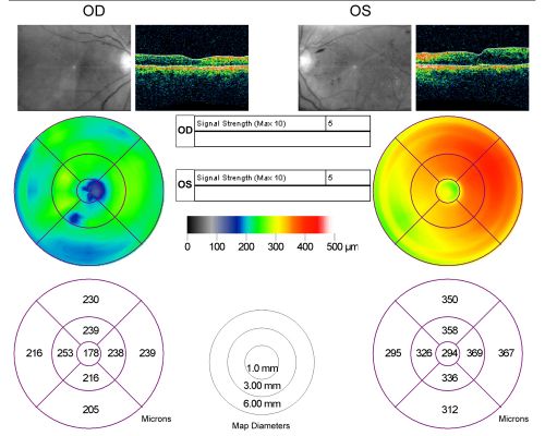 Diabetic Macular Edema Left Eye - Pre Laser
82-year-old woman diabetic for many years, last eye exam 5 years ago with gradual vision loss.  OD 20/60, OS 20/70.  IOP:  OD 16, OS 17.

