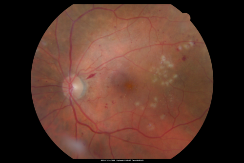Diabetic Macular Edema Left Eye - Post Laser
82-year-old woman diabetic for many years, last eye exam 5 years ago with gradual vision loss.  OD 20/60, OS 20/70.  IOP:  OD 16, OS 17.

