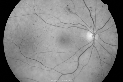 Diabetic Macular Edema Left Eye - Pre Laser
82-year-old woman diabetic for many years, last eye exam 5 years ago with gradual vision loss.  OD 20/60, OS 20/70.  IOP:  OD 16, OS 17.

