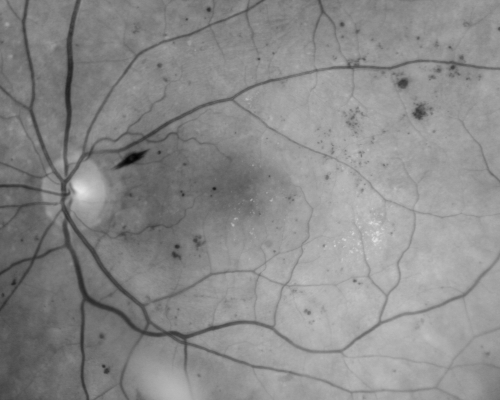 Diabetic Macular Edema Left Eye - Pre Laser
82-year-old woman diabetic for many years, last eye exam 5 years ago with gradual vision loss.  OD 20/60, OS 20/70.  IOP:  OD 16, OS 17.


