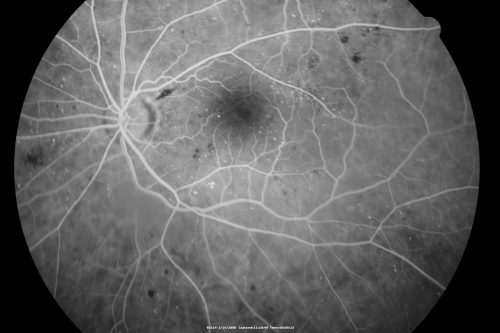 Diabetic Macular Edema Left Eye - Pre Laser
82-year-old woman diabetic for many years, last eye exam 5 years ago with gradual vision loss.  OD 20/60, OS 20/70.  IOP:  OD 16, OS 17.

