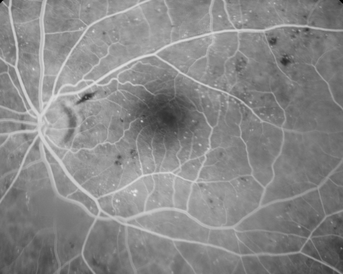 Diabetic Macular Edema Left Eye - Pre Laser
82-year-old woman diabetic for many years, last eye exam 5 years ago with gradual vision loss.  OD 20/60, OS 20/70.  IOP:  OD 16, OS 17.

