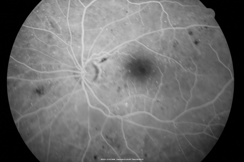 Diabetic Macular Edema Left Eye - Pre Laser
82-year-old woman diabetic for many years, last eye exam 5 years ago with gradual vision loss.  OD 20/60, OS 20/70.  IOP:  OD 16, OS 17.

