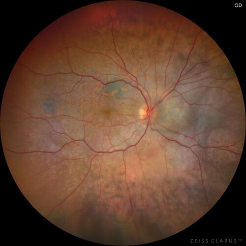 Bilateral Diffuse Melanocytic Proliferation (BDUMP)
67 year old man
The patient started noticing dimming of the vision in November of 2020.Â  He had rapidly worsening cataracts. He had the cataract surgery done in both eyes in April of 2021.Â  The vision did not improve with the cataract surgery.Â  On June 1 of 2021 he had immunotherapy for his renal cell carcinoma and then developed severe vision loss.Â  The patient noticed that one of the commercials for nivolumab (checkpoint inhibitor targeting programmed death receptor-1)  said it may cause vision loss.Â  He recalled that he started the nivolumab in October of 2020 and had vision loss starting then.Â  Â  A retinal evaluation showed subretinal fluid and vision loss. Â  The peripheral vision and central vision were pretty good.Â  The vision did seem to get better off the nivolumab.Â  Then when the patient returned to Florida in September and now the vision is getting worse.Â  The patient did not have any treatments in either eye.Â  The patient is now off the oncology treatment.Â  He was then started on a TKI cabometex for the cancer which was dosed in mid June through mid July just for a month.Â  It was stopped because of a skin rash and reactions.Â Â 
VA OD: Dcc20/200-2 PHNI Ncc20/800
VA OS: Dcc20/63 PHNI NccJ7  He has been off the checkpoint inhibitor for a year.
