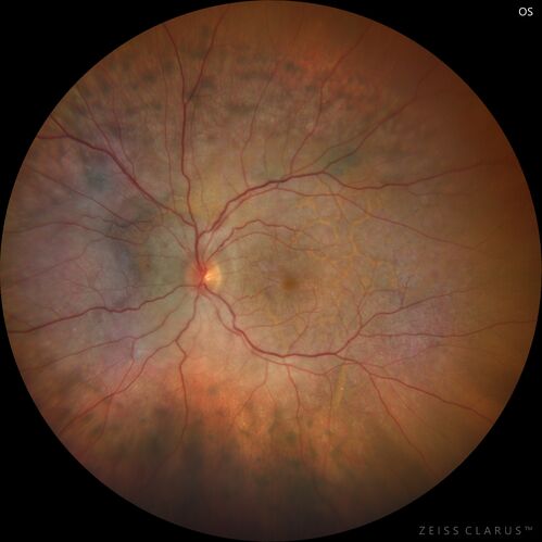 Bilateral Diffuse Melanocytic Proliferation (BDUMP)
67 year old man
The patient started noticing dimming of the vision in November of 2020.Â  He had rapidly worsening cataracts. He had the cataract surgery done in both eyes in April of 2021.Â  The vision did not improve with the cataract surgery.Â  On June 1 of 2021 he had immunotherapy for his renal cell carcinoma and then developed severe vision loss.Â  The patient noticed that one of the commercials for nivolumab (checkpoint inhibitor targeting programmed death receptor-1)  said it may cause vision loss.Â  He recalled that he started the nivolumab in October of 2020 and had vision loss starting then.Â  Â  A retinal evaluation showed subretinal fluid and vision loss. Â  The peripheral vision and central vision were pretty good.Â  The vision did seem to get better off the nivolumab.Â  Then when the patient returned to Florida in September and now the vision is getting worse.Â  The patient did not have any treatments in either eye.Â  The patient is now off the oncology treatment.Â  He was then started on a TKI cabometex for the cancer which was dosed in mid June through mid July just for a month.Â  It was stopped because of a skin rash and reactions.Â Â 
VA OD: Dcc20/200-2 PHNI Ncc20/800
VA OS: Dcc20/63 PHNI NccJ7  He has been off the checkpoint inhibitor for a year.
