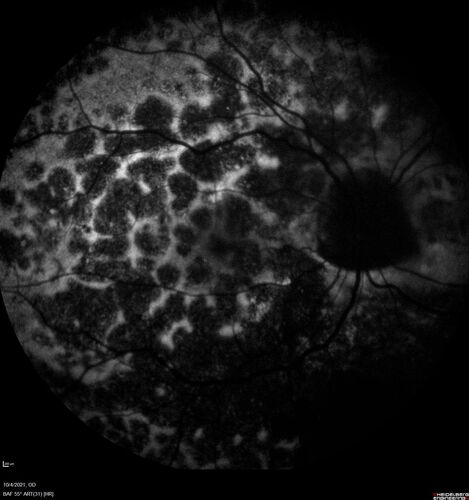 Bilateral Diffuse Melanocytic Proliferation (BDUMP)
67 year old man
The patient started noticing dimming of the vision in November of 2020.Â  He had rapidly worsening cataracts. He had the cataract surgery done in both eyes in April of 2021.Â  The vision did not improve with the cataract surgery.Â  On June 1 of 2021 he had immunotherapy for his renal cell carcinoma and then developed severe vision loss.Â  The patient noticed that one of the commercials for nivolumab (checkpoint inhibitor targeting programmed death receptor-1)  said it may cause vision loss.Â  He recalled that he started the nivolumab in October of 2020 and had vision loss starting then.Â  Â  A retinal evaluation showed subretinal fluid and vision loss. Â  The peripheral vision and central vision were pretty good.Â  The vision did seem to get better off the nivolumab.Â  Then when the patient returned to Florida in September and now the vision is getting worse.Â  The patient did not have any treatments in either eye.Â  The patient is now off the oncology treatment.Â  He was then started on a TKI cabometex for the cancer which was dosed in mid June through mid July just for a month.Â  It was stopped because of a skin rash and reactions.Â Â 
VA OD: Dcc20/200-2 PHNI Ncc20/800
VA OS: Dcc20/63 PHNI NccJ7  He has been off the checkpoint inhibitor for a year.
