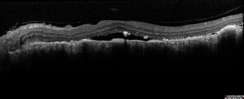 Bilateral Diffuse Melanocytic Proliferation (BDUMP)
67 year old man
The patient started noticing dimming of the vision in November of 2020.Â  He had rapidly worsening cataracts. He had the cataract surgery done in both eyes in April of 2021.Â  The vision did not improve with the cataract surgery.Â  On June 1 of 2021 he had immunotherapy for his renal cell carcinoma and then developed severe vision loss.Â  The patient noticed that one of the commercials for nivolumab (checkpoint inhibitor targeting programmed death receptor-1)  said it may cause vision loss.Â  He recalled that he started the nivolumab in October of 2020 and had vision loss starting then.Â  Â  A retinal evaluation showed subretinal fluid and vision loss. Â  The peripheral vision and central vision were pretty good.Â  The vision did seem to get better off the nivolumab.Â  Then when the patient returned to Florida in September and now the vision is getting worse.Â  The patient did not have any treatments in either eye.Â  The patient is now off the oncology treatment.Â  He was then started on a TKI cabometex for the cancer which was dosed in mid June through mid July just for a month.Â  It was stopped because of a skin rash and reactions.Â Â 
VA OD: Dcc20/200-2 PHNI Ncc20/800
VA OS: Dcc20/63 PHNI NccJ7  He has been off the checkpoint inhibitor for a year.
