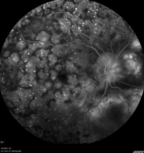 Bilateral Diffuse Melanocytic Proliferation (BDUMP)
67 year old man
The patient started noticing dimming of the vision in November of 2020.Â  He had rapidly worsening cataracts. He had the cataract surgery done in both eyes in April of 2021.Â  The vision did not improve with the cataract surgery.Â  On June 1 of 2021 he had immunotherapy for his renal cell carcinoma and then developed severe vision loss.Â  The patient noticed that one of the commercials for nivolumab (checkpoint inhibitor targeting programmed death receptor-1)  said it may cause vision loss.Â  He recalled that he started the nivolumab in October of 2020 and had vision loss starting then.Â  Â  A retinal evaluation showed subretinal fluid and vision loss. Â  The peripheral vision and central vision were pretty good.Â  The vision did seem to get better off the nivolumab.Â  Then when the patient returned to Florida in September and now the vision is getting worse.Â  The patient did not have any treatments in either eye.Â  The patient is now off the oncology treatment.Â  He was then started on a TKI cabometex for the cancer which was dosed in mid June through mid July just for a month.Â  It was stopped because of a skin rash and reactions.Â Â 
VA OD: Dcc20/200-2 PHNI Ncc20/800
VA OS: Dcc20/63 PHNI NccJ7  He has been off the checkpoint inhibitor for a year.
