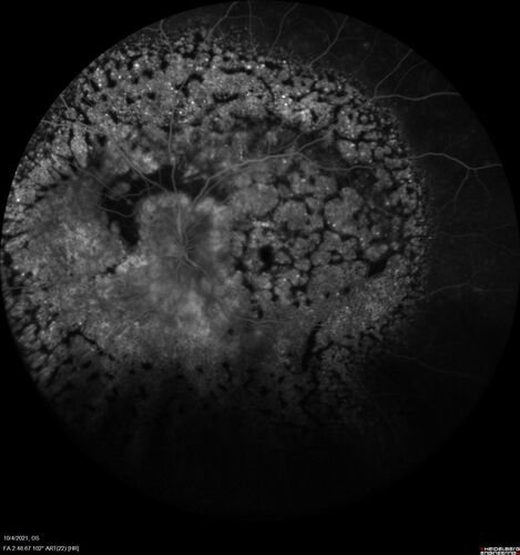 Bilateral Diffuse Melanocytic Proliferation (BDUMP)
67 year old man
The patient started noticing dimming of the vision in November of 2020.Â  He had rapidly worsening cataracts. He had the cataract surgery done in both eyes in April of 2021.Â  The vision did not improve with the cataract surgery.Â  On June 1 of 2021 he had immunotherapy for his renal cell carcinoma and then developed severe vision loss.Â  The patient noticed that one of the commercials for nivolumab (checkpoint inhibitor targeting programmed death receptor-1)  said it may cause vision loss.Â  He recalled that he started the nivolumab in October of 2020 and had vision loss starting then.Â  Â  A retinal evaluation showed subretinal fluid and vision loss. Â  The peripheral vision and central vision were pretty good.Â  The vision did seem to get better off the nivolumab.Â  Then when the patient returned to Florida in September and now the vision is getting worse.Â  The patient did not have any treatments in either eye.Â  The patient is now off the oncology treatment.Â  He was then started on a TKI cabometex for the cancer which was dosed in mid June through mid July just for a month.Â  It was stopped because of a skin rash and reactions.Â Â 
VA OD: Dcc20/200-2 PHNI Ncc20/800
VA OS: Dcc20/63 PHNI NccJ7  He has been off the checkpoint inhibitor for a year.
