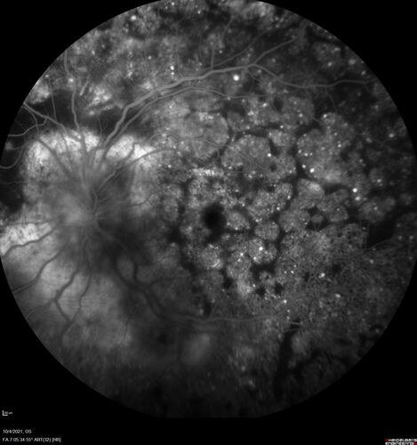 Bilateral Diffuse Melanocytic Proliferation (BDUMP)
67 year old man
The patient started noticing dimming of the vision in November of 2020.Â  He had rapidly worsening cataracts. He had the cataract surgery done in both eyes in April of 2021.Â  The vision did not improve with the cataract surgery.Â  On June 1 of 2021 he had immunotherapy for his renal cell carcinoma and then developed severe vision loss.Â  The patient noticed that one of the commercials for nivolumab (checkpoint inhibitor targeting programmed death receptor-1)  said it may cause vision loss.Â  He recalled that he started the nivolumab in October of 2020 and had vision loss starting then.Â  Â  A retinal evaluation showed subretinal fluid and vision loss. Â  The peripheral vision and central vision were pretty good.Â  The vision did seem to get better off the nivolumab.Â  Then when the patient returned to Florida in September and now the vision is getting worse.Â  The patient did not have any treatments in either eye.Â  The patient is now off the oncology treatment.Â  He was then started on a TKI cabometex for the cancer which was dosed in mid June through mid July just for a month.Â  It was stopped because of a skin rash and reactions.Â Â 
VA OD: Dcc20/200-2 PHNI Ncc20/800
VA OS: Dcc20/63 PHNI NccJ7  He has been off the checkpoint inhibitor for a year.
