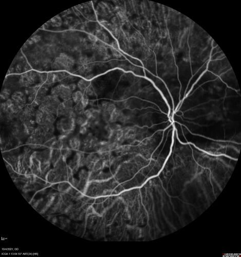 Bilateral Diffuse Melanocytic Proliferation (BDUMP)
67 year old man
The patient started noticing dimming of the vision in November of 2020.Â  He had rapidly worsening cataracts. He had the cataract surgery done in both eyes in April of 2021.Â  The vision did not improve with the cataract surgery.Â  On June 1 of 2021 he had immunotherapy for his renal cell carcinoma and then developed severe vision loss.Â  The patient noticed that one of the commercials for nivolumab (checkpoint inhibitor targeting programmed death receptor-1)  said it may cause vision loss.Â  He recalled that he started the nivolumab in October of 2020 and had vision loss starting then.Â  Â  A retinal evaluation showed subretinal fluid and vision loss. Â  The peripheral vision and central vision were pretty good.Â  The vision did seem to get better off the nivolumab.Â  Then when the patient returned to Florida in September and now the vision is getting worse.Â  The patient did not have any treatments in either eye.Â  The patient is now off the oncology treatment.Â  He was then started on a TKI cabometex for the cancer which was dosed in mid June through mid July just for a month.Â  It was stopped because of a skin rash and reactions.Â Â 
VA OD: Dcc20/200-2 PHNI Ncc20/800
VA OS: Dcc20/63 PHNI NccJ7  He has been off the checkpoint inhibitor for a year.
