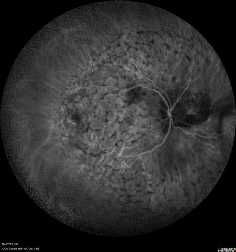 Bilateral Diffuse Melanocytic Proliferation (BDUMP)
67 year old man
The patient started noticing dimming of the vision in November of 2020.Â  He had rapidly worsening cataracts. He had the cataract surgery done in both eyes in April of 2021.Â  The vision did not improve with the cataract surgery.Â  On June 1 of 2021 he had immunotherapy for his renal cell carcinoma and then developed severe vision loss.Â  The patient noticed that one of the commercials for nivolumab (checkpoint inhibitor targeting programmed death receptor-1)  said it may cause vision loss.Â  He recalled that he started the nivolumab in October of 2020 and had vision loss starting then.Â  Â  A retinal evaluation showed subretinal fluid and vision loss. Â  The peripheral vision and central vision were pretty good.Â  The vision did seem to get better off the nivolumab.Â  Then when the patient returned to Florida in September and now the vision is getting worse.Â  The patient did not have any treatments in either eye.Â  The patient is now off the oncology treatment.Â  He was then started on a TKI cabometex for the cancer which was dosed in mid June through mid July just for a month.Â  It was stopped because of a skin rash and reactions.Â Â 
VA OD: Dcc20/200-2 PHNI Ncc20/800
VA OS: Dcc20/63 PHNI NccJ7  He has been off the checkpoint inhibitor for a year.
