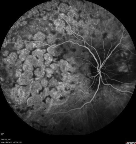 Bilateral Diffuse Melanocytic Proliferation (BDUMP)
67 year old man
The patient started noticing dimming of the vision in November of 2020.Â  He had rapidly worsening cataracts. He had the cataract surgery done in both eyes in April of 2021.Â  The vision did not improve with the cataract surgery.Â  On June 1 of 2021 he had immunotherapy for his renal cell carcinoma and then developed severe vision loss.Â  The patient noticed that one of the commercials for nivolumab (checkpoint inhibitor targeting programmed death receptor-1)  said it may cause vision loss.Â  He recalled that he started the nivolumab in October of 2020 and had vision loss starting then.Â  Â  A retinal evaluation showed subretinal fluid and vision loss. Â  The peripheral vision and central vision were pretty good.Â  The vision did seem to get better off the nivolumab.Â  Then when the patient returned to Florida in September and now the vision is getting worse.Â  The patient did not have any treatments in either eye.Â  The patient is now off the oncology treatment.Â  He was then started on a TKI cabometex for the cancer which was dosed in mid June through mid July just for a month.Â  It was stopped because of a skin rash and reactions.Â Â 
VA OD: Dcc20/200-2 PHNI Ncc20/800
VA OS: Dcc20/63 PHNI NccJ7  He has been off the checkpoint inhibitor for a year.
