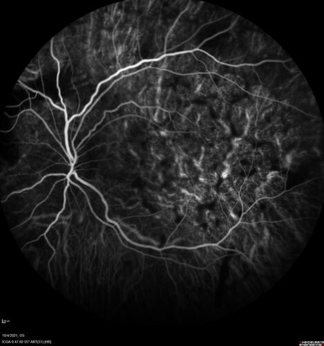Bilateral Diffuse Melanocytic Proliferation (BDUMP)
67 year old man
The patient started noticing dimming of the vision in November of 2020.Â  He had rapidly worsening cataracts. He had the cataract surgery done in both eyes in April of 2021.Â  The vision did not improve with the cataract surgery.Â  On June 1 of 2021 he had immunotherapy for his renal cell carcinoma and then developed severe vision loss.Â  The patient noticed that one of the commercials for nivolumab (checkpoint inhibitor targeting programmed death receptor-1)  said it may cause vision loss.Â  He recalled that he started the nivolumab in October of 2020 and had vision loss starting then.Â  Â  A retinal evaluation showed subretinal fluid and vision loss. Â  The peripheral vision and central vision were pretty good.Â  The vision did seem to get better off the nivolumab.Â  Then when the patient returned to Florida in September and now the vision is getting worse.Â  The patient did not have any treatments in either eye.Â  The patient is now off the oncology treatment.Â  He was then started on a TKI cabometex for the cancer which was dosed in mid June through mid July just for a month.Â  It was stopped because of a skin rash and reactions.Â Â 
VA OD: Dcc20/200-2 PHNI Ncc20/800
VA OS: Dcc20/63 PHNI NccJ7  He has been off the checkpoint inhibitor for a year.
