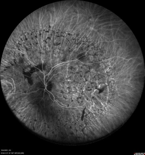Bilateral Diffuse Melanocytic Proliferation (BDUMP)
67 year old man
The patient started noticing dimming of the vision in November of 2020.Â  He had rapidly worsening cataracts. He had the cataract surgery done in both eyes in April of 2021.Â  The vision did not improve with the cataract surgery.Â  On June 1 of 2021 he had immunotherapy for his renal cell carcinoma and then developed severe vision loss.Â  The patient noticed that one of the commercials for nivolumab (checkpoint inhibitor targeting programmed death receptor-1)  said it may cause vision loss.Â  He recalled that he started the nivolumab in October of 2020 and had vision loss starting then.Â  Â  A retinal evaluation showed subretinal fluid and vision loss. Â  The peripheral vision and central vision were pretty good.Â  The vision did seem to get better off the nivolumab.Â  Then when the patient returned to Florida in September and now the vision is getting worse.Â  The patient did not have any treatments in either eye.Â  The patient is now off the oncology treatment.Â  He was then started on a TKI cabometex for the cancer which was dosed in mid June through mid July just for a month.Â  It was stopped because of a skin rash and reactions.Â Â 
VA OD: Dcc20/200-2 PHNI Ncc20/800
VA OS: Dcc20/63 PHNI NccJ7  He has been off the checkpoint inhibitor for a year.
