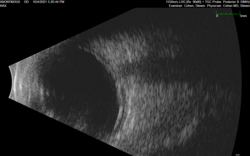 Bilateral Diffuse Melanocytic Proliferation (BDUMP)
67 year old man
The patient started noticing dimming of the vision in November of 2020.Â  He had rapidly worsening cataracts. He had the cataract surgery done in both eyes in April of 2021.Â  The vision did not improve with the cataract surgery.Â  On June 1 of 2021 he had immunotherapy for his renal cell carcinoma and then developed severe vision loss.Â  The patient noticed that one of the commercials for nivolumab (checkpoint inhibitor targeting programmed death receptor-1)  said it may cause vision loss.Â  He recalled that he started the nivolumab in October of 2020 and had vision loss starting then.Â  Â  A retinal evaluation showed subretinal fluid and vision loss. Â  The peripheral vision and central vision were pretty good.Â  The vision did seem to get better off the nivolumab.Â  Then when the patient returned to Florida in September and now the vision is getting worse.Â  The patient did not have any treatments in either eye.Â  The patient is now off the oncology treatment.Â  He was then started on a TKI cabometex for the cancer which was dosed in mid June through mid July just for a month.Â  It was stopped because of a skin rash and reactions.Â Â 
VA OD: Dcc20/200-2 PHNI Ncc20/800
VA OS: Dcc20/63 PHNI NccJ7  He has been off the checkpoint inhibitor for a year.
