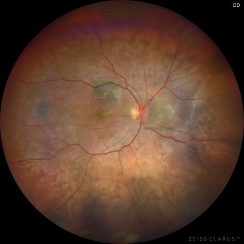 Bilateral Diffuse Melanocytic Proliferation (BDUMP)
67 year old man
The patient started noticing dimming of the vision in November of 2020.Â  He had rapidly worsening cataracts. He had the cataract surgery done in both eyes in April of 2021.Â  The vision did not improve with the cataract surgery.Â  On June 1 of 2021 he had immunotherapy for his renal cell carcinoma and then developed severe vision loss.Â  The patient noticed that one of the commercials for nivolumab (checkpoint inhibitor targeting programmed death receptor-1)  said it may cause vision loss.Â  He recalled that he started the nivolumab in October of 2020 and had vision loss starting then.Â  Â  A retinal evaluation showed subretinal fluid and vision loss. Â  The peripheral vision and central vision were pretty good.Â  The vision did seem to get better off the nivolumab.Â  Then when the patient returned to Florida in September and now the vision is getting worse.Â  The patient did not have any treatments in either eye.Â  The patient is now off the oncology treatment.Â  He was then started on a TKI cabometex for the cancer which was dosed in mid June through mid July just for a month.Â  It was stopped because of a skin rash and reactions.Â Â 
VA OD: Dcc20/200-2 PHNI Ncc20/800
VA OS: Dcc20/63 PHNI NccJ7  He has been off the checkpoint inhibitor for a year.
