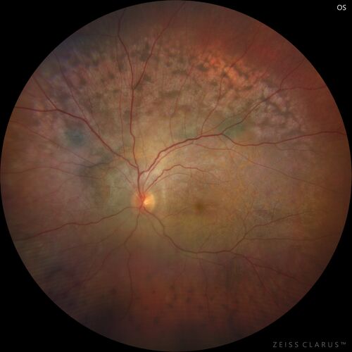 Bilateral Diffuse Melanocytic Proliferation (BDUMP)
67 year old man
The patient started noticing dimming of the vision in November of 2020.Â  He had rapidly worsening cataracts. He had the cataract surgery done in both eyes in April of 2021.Â  The vision did not improve with the cataract surgery.Â  On June 1 of 2021 he had immunotherapy for his renal cell carcinoma and then developed severe vision loss.Â  The patient noticed that one of the commercials for nivolumab (checkpoint inhibitor targeting programmed death receptor-1)  said it may cause vision loss.Â  He recalled that he started the nivolumab in October of 2020 and had vision loss starting then.Â  Â  A retinal evaluation showed subretinal fluid and vision loss. Â  The peripheral vision and central vision were pretty good.Â  The vision did seem to get better off the nivolumab.Â  Then when the patient returned to Florida in September and now the vision is getting worse.Â  The patient did not have any treatments in either eye.Â  The patient is now off the oncology treatment.Â  He was then started on a TKI cabometex for the cancer which was dosed in mid June through mid July just for a month.Â  It was stopped because of a skin rash and reactions.Â Â 
VA OD: Dcc20/200-2 PHNI Ncc20/800
VA OS: Dcc20/63 PHNI NccJ7  He has been off the checkpoint inhibitor for a year.
