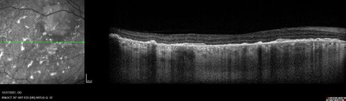 Bilateral Diffuse Melanocytic Proliferation (BDUMP)
67 year old man
Vision is better after 14 plasma exchanges, OD 20/160, OS 20/32
