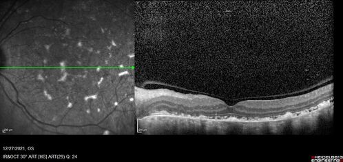 Bilateral Diffuse Melanocytic Proliferation (BDUMP)
67 year old man
Vision is better after 14 plasma exchanges, OD 20/160, OS 20/32
