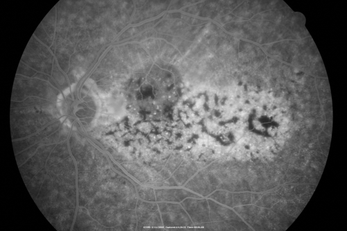 Bilateral Diffuse Uveal Melanocytic Proliferation - BDUMP - Paraneoplastic Syndrome
80-year-old man vision loss for one year.  He died about one year after these photos from Metastatic Poorly Differentiated Large Cell Carcinoma of unknown primary.  He was a smoker. 
Palabras clave: bdump;bilateral diffuse uveal melanocytic proliferation;pigmented