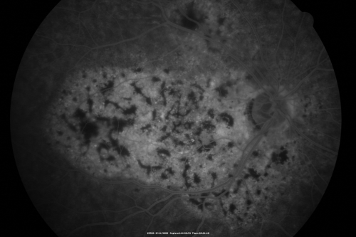 Bilateral Diffuse Uveal Melanocytic Proliferation - BDUMP - Paraneoplastic Syndrome
80-year-old man vision loss for one year.  He died about one year after these photos from Metastatic Poorly Differentiated Large Cell Carcinoma of unknown primary.  He was a smoker. 
Keywords: bdump;bilateral diffuse uveal melanocytic proliferation;pigmented