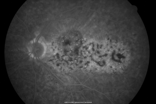 Bilateral Diffuse Uveal Melanocytic Proliferation - BDUMP - Paraneoplastic Syndrome
80-year-old man vision loss for one year.  He died about one year after these photos from Metastatic Poorly Differentiated Large Cell Carcinoma of unknown primary.  He was a smoker. 
Keywords: bdump;bilateral diffuse uveal melanocytic proliferation;pigmented