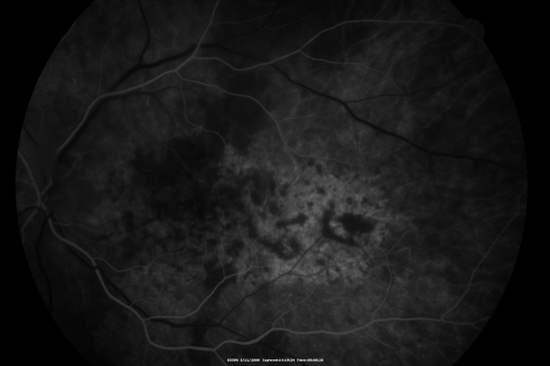 Bilateral Diffuse Uveal Melanocytic Proliferation - BDUMP - Paraneoplastic Syndrome
80-year-old man vision loss for one year.  He died about one year after these photos from Metastatic Poorly Differentiated Large Cell Carcinoma of unknown primary.  He was a smoker. 
Keywords: bdump;bilateral diffuse uveal melanocytic proliferation;pigmented