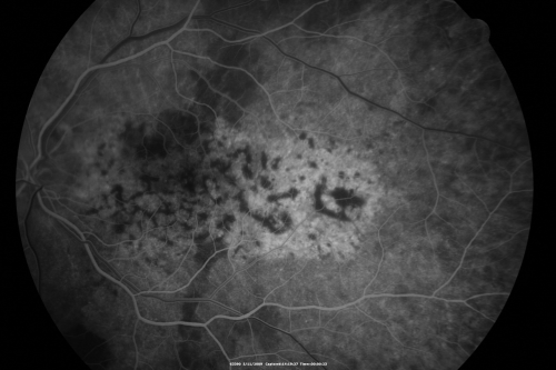 Bilateral Diffuse Uveal Melanocytic Proliferation - BDUMP - Paraneoplastic Syndrome
80-year-old man vision loss for one year.  He died about one year after these photos from Metastatic Poorly Differentiated Large Cell Carcinoma of unknown primary.  He was a smoker. 
Keywords: bdump;bilateral diffuse uveal melanocytic proliferation;pigmented