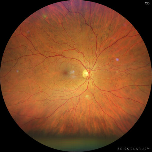 Bear tracks (and diabetic retinopathy)
48 year old female with bear tracks in her retina and NPDR.

