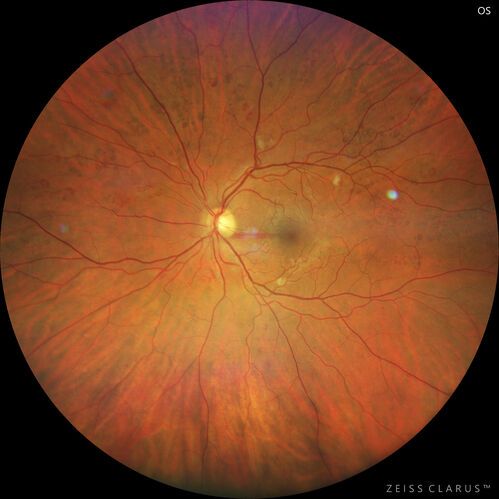 Bear tracks (and diabetic retinopathy)
48 year old female with bear tracks in her retina and NPDR.
