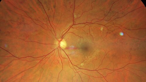 Bear tracks (and diabetic retinopathy)
48 year old female with bear tracks in her retina and NPDR.
