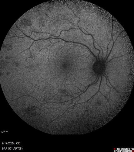 Bear tracks (and diabetic retinopathy)
48 year old female with bear tracks in her retina and NPDR.
