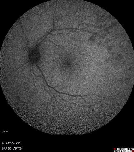 Bear tracks (and diabetic retinopathy)
48 year old female with bear tracks in her retina and NPDR.
