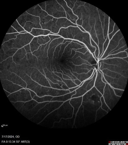 Bear tracks (and diabetic retinopathy)
48 year old female with bear tracks in her retina and NPDR.
