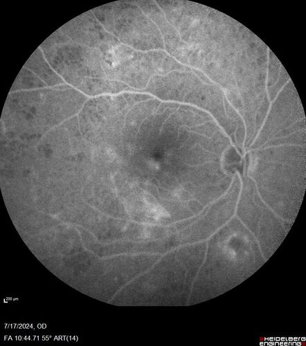 Bear tracks (and diabetic retinopathy)
48 year old female with bear tracks in her retina and NPDR.
