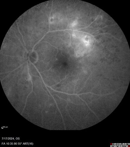 Bear tracks (and diabetic retinopathy)
48 year old female with bear tracks in her retina and NPDR.
