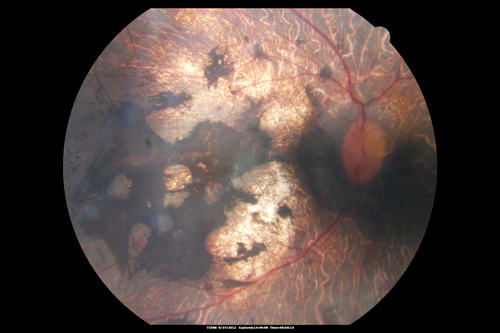 Retinitis Pigmentosa - Autosomal Dominant - Vision Loss at Young Age - Fundus Photo
 54-year-old woman has autosomal dominant retinitis pigmentosa.  Her mother and grandmother both had it and she has one son who has it and one daughter who doesnâ€™t.  She also has a sister with it.  She lost vision since she was younger.  She had cataract surgery done in January and February of this year.  She has been seeing unusual flashing lights throughout the periphery and central vision for about the last year or two.  

VISUAL ACUITY:  OD 20/160,  OS 20/160
