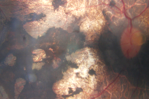 Retinitis Pigmentosa - Autosomal Dominant - Vision Loss at Young Age - Fundus Photo
 54-year-old woman has autosomal dominant retinitis pigmentosa.  Her mother and grandmother both had it and she has one son who has it and one daughter who doesnâ€™t.  She also has a sister with it.  She lost vision since she was younger.  She had cataract surgery done in January and February of this year.  She has been seeing unusual flashing lights throughout the periphery and central vision for about the last year or two.  

VISUAL ACUITY:  OD 20/160,  OS 20/160
