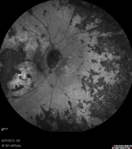Retinitis Pigmentosa - Autosomal Dominant - Vision Loss at Young Age - Infrared
 54-year-old woman has autosomal dominant retinitis pigmentosa.  Her mother and grandmother both had it and she has one son who has it and one daughter who doesnâ€™t.  She also has a sister with it.  She lost vision since she was younger.  She had cataract surgery done in January and February of this year.  She has been seeing unusual flashing lights throughout the periphery and central vision for about the last year or two.  

VISUAL ACUITY:  OD 20/160,  OS 20/160
