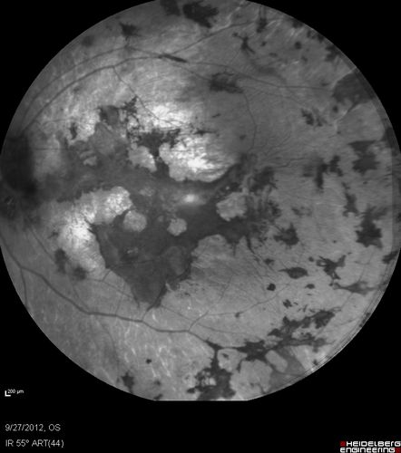 Retinitis Pigmentosa - Autosomal Dominant - Vision Loss at Young Age - Infrared
 54-year-old woman has autosomal dominant retinitis pigmentosa.  Her mother and grandmother both had it and she has one son who has it and one daughter who doesnâ€™t.  She also has a sister with it.  She lost vision since she was younger.  She had cataract surgery done in January and February of this year.  She has been seeing unusual flashing lights throughout the periphery and central vision for about the last year or two.  

VISUAL ACUITY:  OD 20/160,  OS 20/160
