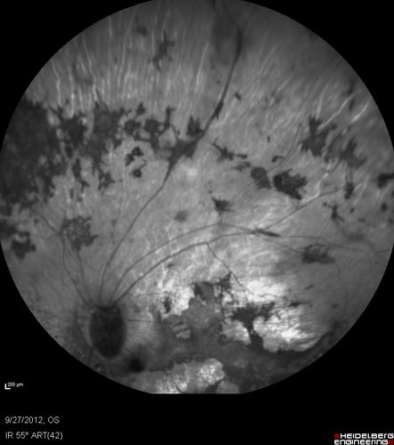 Retinitis Pigmentosa - Autosomal Dominant - Vision Loss at Young Age - Infrared
 54-year-old woman has autosomal dominant retinitis pigmentosa.  Her mother and grandmother both had it and she has one son who has it and one daughter who doesnâ€™t.  She also has a sister with it.  She lost vision since she was younger.  She had cataract surgery done in January and February of this year.  She has been seeing unusual flashing lights throughout the periphery and central vision for about the last year or two.  

VISUAL ACUITY:  OD 20/160,  OS 20/160
