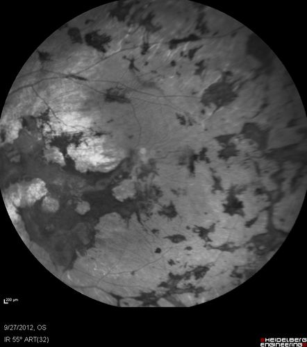 Retinitis Pigmentosa - Autosomal Dominant - Vision Loss at Young Age - Infrared
 54-year-old woman has autosomal dominant retinitis pigmentosa.  Her mother and grandmother both had it and she has one son who has it and one daughter who doesnâ€™t.  She also has a sister with it.  She lost vision since she was younger.  She had cataract surgery done in January and February of this year.  She has been seeing unusual flashing lights throughout the periphery and central vision for about the last year or two.  

VISUAL ACUITY:  OD 20/160,  OS 20/160
