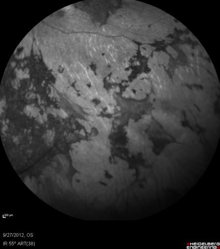 Retinitis Pigmentosa - Autosomal Dominant - Vision Loss at Young Age - Infrared
 54-year-old woman has autosomal dominant retinitis pigmentosa.  Her mother and grandmother both had it and she has one son who has it and one daughter who doesnâ€™t.  She also has a sister with it.  She lost vision since she was younger.  She had cataract surgery done in January and February of this year.  She has been seeing unusual flashing lights throughout the periphery and central vision for about the last year or two.  

VISUAL ACUITY:  OD 20/160,  OS 20/160
