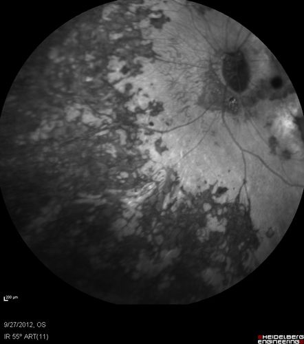 Retinitis Pigmentosa - Autosomal Dominant - Vision Loss at Young Age - Infrared
 54-year-old woman has autosomal dominant retinitis pigmentosa.  Her mother and grandmother both had it and she has one son who has it and one daughter who doesnâ€™t.  She also has a sister with it.  She lost vision since she was younger.  She had cataract surgery done in January and February of this year.  She has been seeing unusual flashing lights throughout the periphery and central vision for about the last year or two.  

VISUAL ACUITY:  OD 20/160,  OS 20/160
