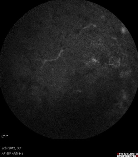Retinitis Pigmentosa - Autosomal Dominant - Vision Loss at Young Age - Autofluorescence
 54-year-old woman has autosomal dominant retinitis pigmentosa.  Her mother and grandmother both had it and she has one son who has it and one daughter who doesnâ€™t.  She also has a sister with it.  She lost vision since she was younger.  She had cataract surgery done in January and February of this year.  She has been seeing unusual flashing lights throughout the periphery and central vision for about the last year or two.  

VISUAL ACUITY:  OD 20/160,  OS 20/160
